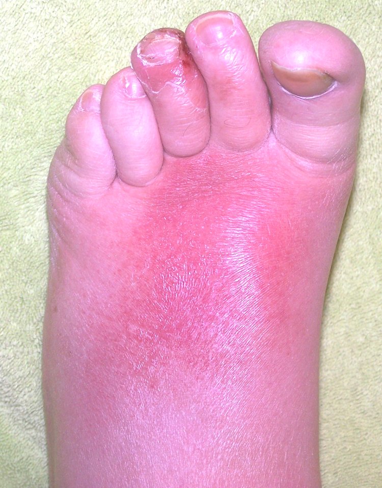 Holiday Foot Problems? Andrew Clarke Podiatrist